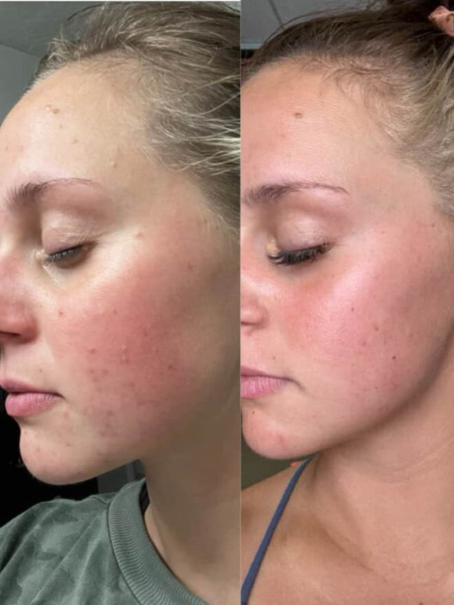 Before and after comparison of a woman's face with visible acne on the left, and clearer skin on the right.